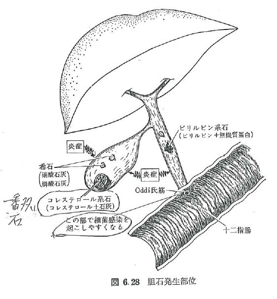胆石持ち・胆のうのない人 ・・・ 胆汁が薄い